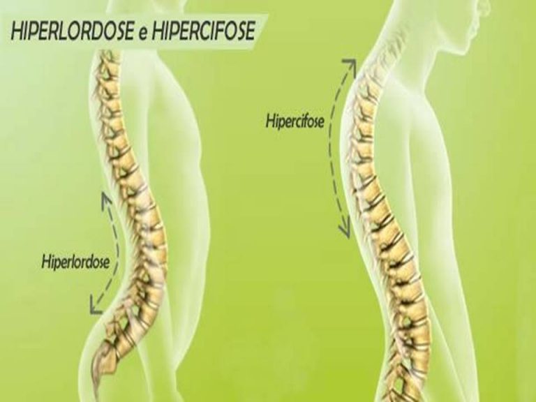 HIPERCIFOSE HIPERLORDOSE JV Tep